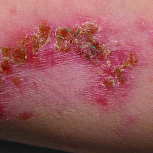 Skin_Infections