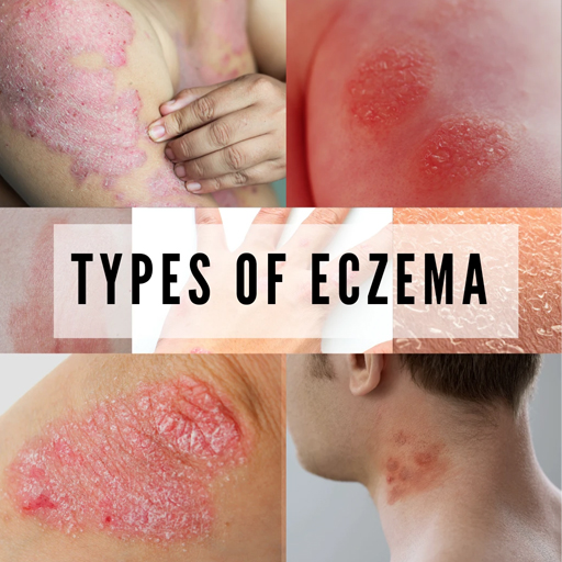 eczema